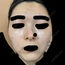 ニードルRF（ポテンツァなど） GRACY TOKYO CLINIC【グレイシートウキョウクリニック】 AFTER サムネイル用