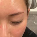 ダーマペン LIFIX BEAUTY CLINIC DAY 3 サムネイル用