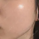 エレクトロポレーション / ルメッカ ON-CLINIC Beauty DAY 0 サムネイル用