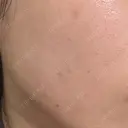 エレクトロポレーション / ルメッカ ON-CLINIC Beauty DAY 10 サムネイル用