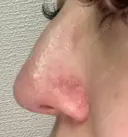 鼻尖形成（切開） / 小鼻縮小（切開） / 軟骨移植 / 鼻尖縮小 東京シンデレラ美容外科 新宿院 DAY 121 サムネイル用