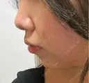 ヒアルロン酸注入（あご） / ヒアルロン酸注入（鼻翼基部） / RF（高周波）たるみ治療 gift clinic DAY 2 サムネイル用