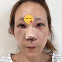 鼻尖形成（切開） / 鼻中隔延長（切開） / 糸リフト / 軟骨移植 / 骨切幅寄せ / 鼻孔縁挙上 / 鼻柱下降・鼻唇角形成（猫手術） / 肌ヒアルロン酸注入（たるみ・シワ改善） / ヒアルロン酸注入（あご） / ボトックス（額） / ヒアルロン酸注入（鼻翼基部） 大阪TAクリニック DAY 0 サムネイル用