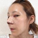 鼻尖形成（切開） / 鼻中隔延長（切開） / 糸リフト / 軟骨移植 / 骨切幅寄せ / 鼻孔縁挙上 / 鼻柱下降・鼻唇角形成（猫手術） / 肌ヒアルロン酸注入（たるみ・シワ改善） / ヒアルロン酸注入（あご） / ボトックス（額） / ヒアルロン酸注入（鼻翼基部） 大阪TAクリニック DAY 0 サムネイル用