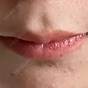 ヒアルロン酸注入（唇） フィラークリニック 大阪梅田院 DAY 7 サムネイル用