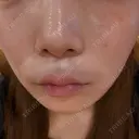 ルメッカ 大美会クリニック 梅田院 AFTER サムネイル用