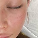 ダーマペン LIFIX BEAUTY CLINIC AFTER サムネイル用
