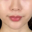 肌ヒアルロン酸注入（たるみ・シワ改善） / ヒアルロン酸注入（あご） アリエル美容クリニック 大宮院 AFTER サムネイル用