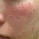 フォトRF 共立美容外科 仙台院 DAY 0 サムネイル用