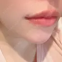 ヒアルロン酸注入（唇） AZ BEAUTY CLINIC DAY 2 サムネイル用