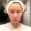 糸リフト / 脂肪吸引（顔） / ジョールファット除去 A CLINIC（エークリニック） 新宿院 AFTER サムネイル用