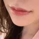 ヒアルロン酸注入（唇） AZ BEAUTY CLINIC DAY 3 サムネイル用