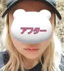 ボトックス（エラ・小顔） / ヒアルロン酸注入（唇） / ボトックス（首） ROHE CLINIC GINZA DAY 8 サムネイル用