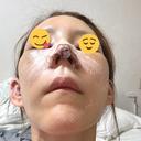鼻尖形成（切開） / 鼻中隔延長（切開） / 糸リフト / 軟骨移植 / 骨切幅寄せ / 鼻孔縁挙上 / 鼻柱下降・鼻唇角形成（猫手術） / 肌ヒアルロン酸注入（たるみ・シワ改善） / ヒアルロン酸注入（あご） / ボトックス（額） / ヒアルロン酸注入（鼻翼基部） 大阪TAクリニック DAY 1 サムネイル用