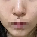 ポテンツァ ルラ美容クリニック 岡山院 AFTER サムネイル用