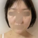 RF（高周波）たるみ治療 ルラ美容クリニック 福岡本院 DAY 4 サムネイル用