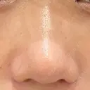 鼻尖形成（切開） / 小鼻縮小（切開） / 軟骨移植 ブルームクリニック（BLOOM CLINIC） DAY 28 サムネイル用