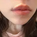 ヒアルロン酸注入（唇） AZ BEAUTY CLINIC DAY 4 サムネイル用