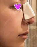 鼻尖形成（切開） / 鼻中隔延長（切開） / 骨切幅寄せ 韓国BBクリニック（旧 シンミアン形成外科） DAY 3 サムネイル用