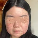 美肌レーザー / 赤み除去レーザー / ニキビ治療 医療法人河田外科形成外科 AFTER サムネイル用