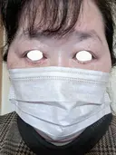 下まぶたたるみ取り / 下まぶたの脂肪取り / 脂肪注入（目の下） アリエル美容クリニック 郡山院 DAY 125 サムネイル用