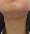 RF（高周波）たるみ治療 ルラ美容クリニック 札幌本院 DAY 0 サムネイル用