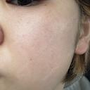 ピーリング（ハリ・ツヤ） / ルメッカ PureMe Skin Clinic（ピュアミースキンクリニック麻布） AFTER サムネイル用