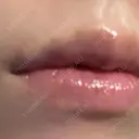 ヒアルロン酸注入（唇） AZ BEAUTY CLINIC DAY 5 サムネイル用