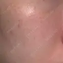 フォトRF 共立美容外科 仙台院 DAY 3 サムネイル用