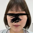 RF（高周波）たるみ治療 ルラ美容クリニック 福岡本院 DAY 5 サムネイル用