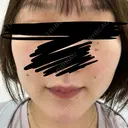 RF（高周波）たるみ治療 ルラ美容クリニック 福岡本院 DAY 6 サムネイル用