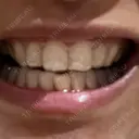 ホワイトニング 緑のテラス歯科クリニック AFTER サムネイル用