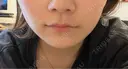 その他（鼻） / ボトックス（あご） / ボトックス（口角） / ボトックス（眉間） / ボトックス（人中） TCB東京中央美容外科 岡山院 AFTER サムネイル用