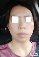 エレクトロポレーション / 毛穴洗浄（ハイドラフェイシャルなど） / 光治療（フォトフェイシャルなど） Leap beauty clinic DAY 4 サムネイル用