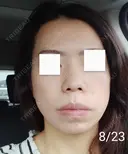 エレクトロポレーション / 毛穴洗浄（ハイドラフェイシャルなど） / 光治療（フォトフェイシャルなど） Leap beauty clinic DAY 5 サムネイル用