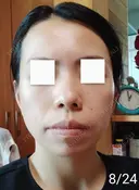 エレクトロポレーション / 毛穴洗浄（ハイドラフェイシャルなど） / 光治療（フォトフェイシャルなど） Leap beauty clinic DAY 6 サムネイル用