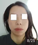 エレクトロポレーション / 毛穴洗浄（ハイドラフェイシャルなど） / 光治療（フォトフェイシャルなど） Leap beauty clinic DAY 7 サムネイル用