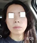 エレクトロポレーション / 毛穴洗浄（ハイドラフェイシャルなど） / 光治療（フォトフェイシャルなど） Leap beauty clinic DAY 8 サムネイル用