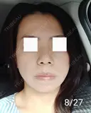 エレクトロポレーション / 毛穴洗浄（ハイドラフェイシャルなど） / 光治療（フォトフェイシャルなど） Leap beauty clinic DAY 9 サムネイル用