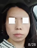 エレクトロポレーション / 毛穴洗浄（ハイドラフェイシャルなど） / 光治療（フォトフェイシャルなど） Leap beauty clinic DAY 10 サムネイル用