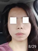 エレクトロポレーション / 毛穴洗浄（ハイドラフェイシャルなど） / 光治療（フォトフェイシャルなど） Leap beauty clinic DAY 11 サムネイル用