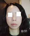 エレクトロポレーション / 毛穴洗浄（ハイドラフェイシャルなど） / 光治療（フォトフェイシャルなど） Leap beauty clinic AFTER サムネイル用