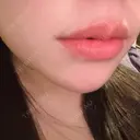 ヒアルロン酸注入（唇） AZ BEAUTY CLINIC DAY 6 サムネイル用