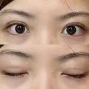 二重埋没 R.O.clinic DAY 10 サムネイル用