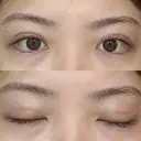 二重埋没 R.O.clinic DAY 14 サムネイル用