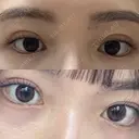 二重埋没 R.O.clinic DAY 61 サムネイル用