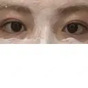 二重埋没 R.O.clinic DAY 111 サムネイル用