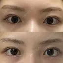 二重埋没 R.O.clinic DAY 127 サムネイル用