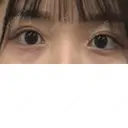 二重埋没 R.O.clinic DAY 148 サムネイル用