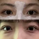 二重埋没 R.O.clinic AFTER サムネイル用